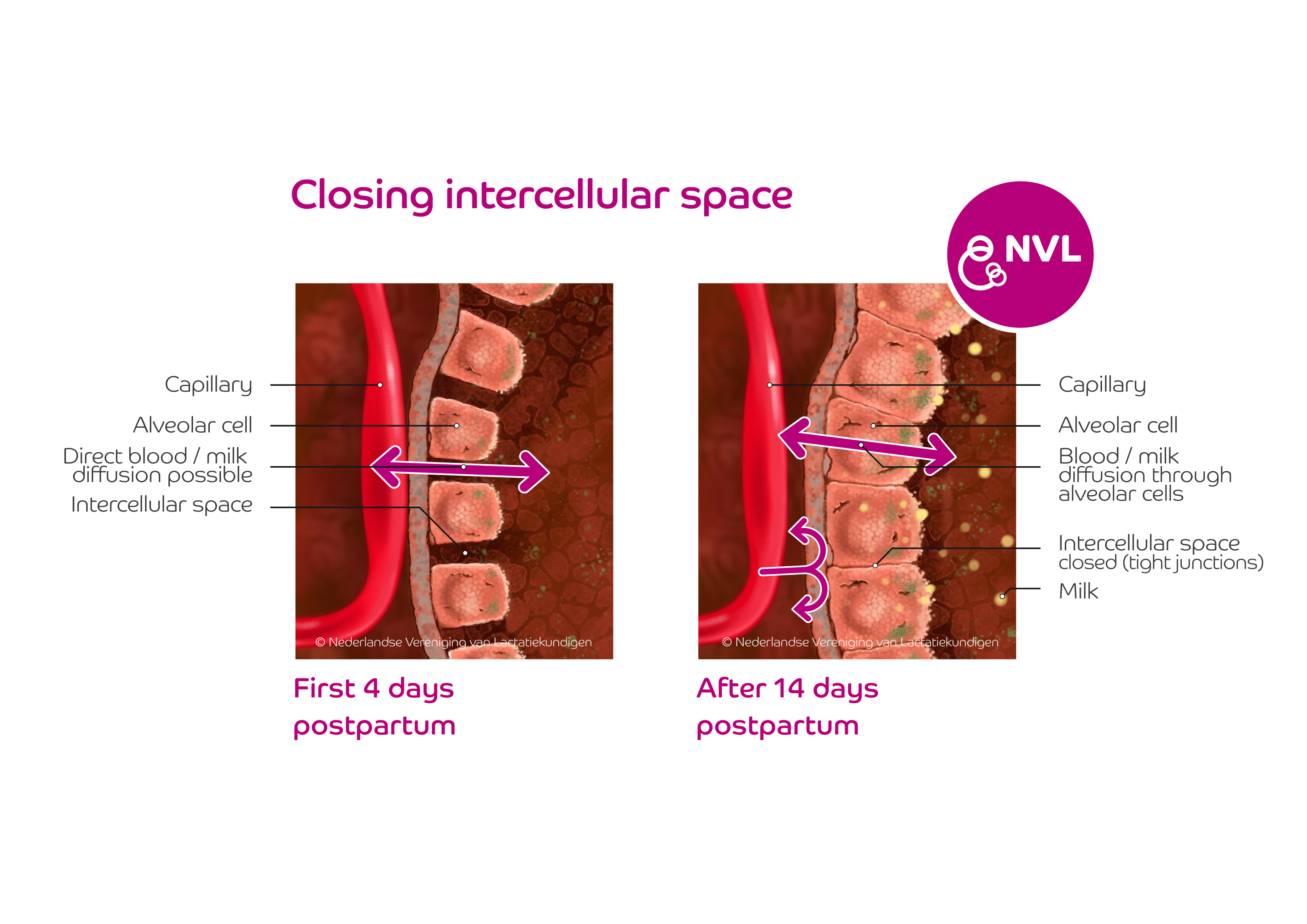 Closing intercellulair space breasttissue | NVL